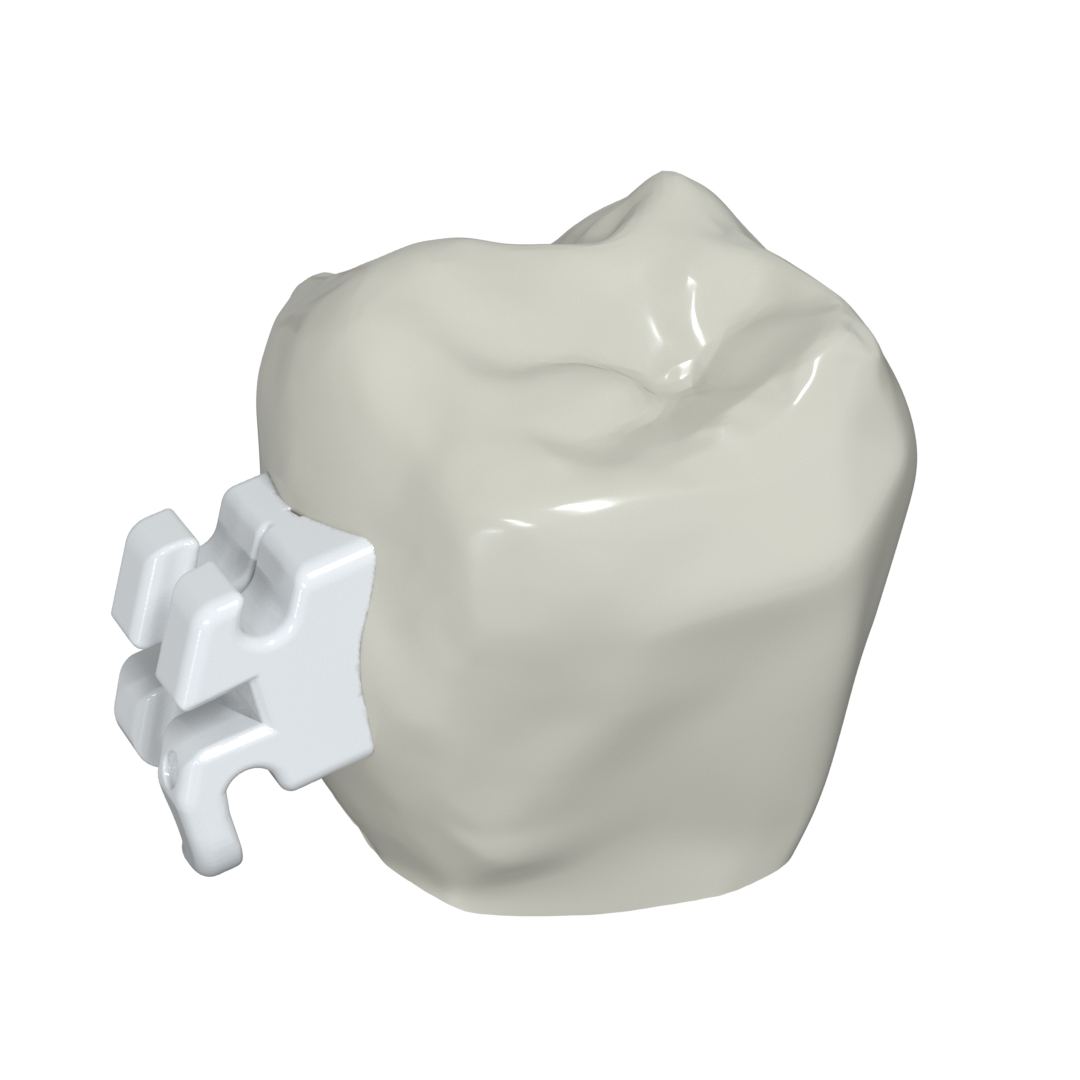 LightForce custom braces compared with traditional orthodontic braces