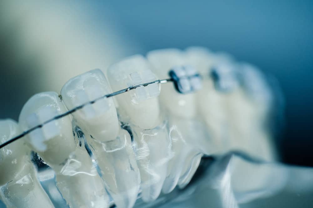 lightForce Braces VS Traditional Braces — orthodontic guidance from Dr. Suzanne Dennis