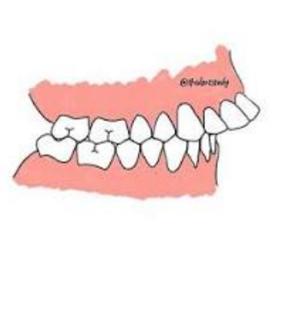Class II correction guidance from Dr. Suzanne Dennis for prominent upper teeth and a retrusive lower jaw