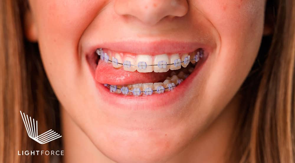 How Long Do Orthodontic Braces Take in Charlottesville, VA? — orthodontic guidance from Dr. Suzanne Dennis