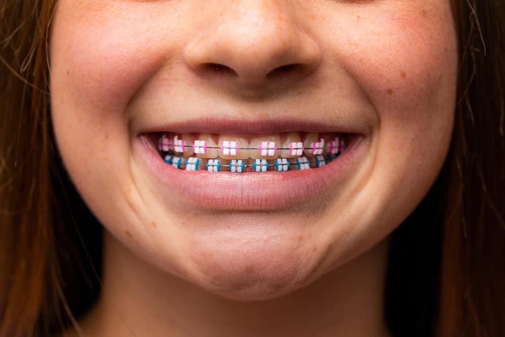 How Much Do Braces Cost in Charlottesville, VA? (Complete 2026 Guide) — orthodontic guidance from Dr. Suzanne Dennis