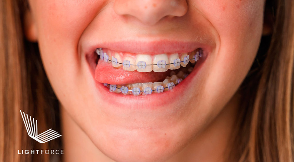 How Long Do Orthodontic Braces Take in Charlottesville, VA? — orthodontic guidance from Dr. Suzanne Dennis
