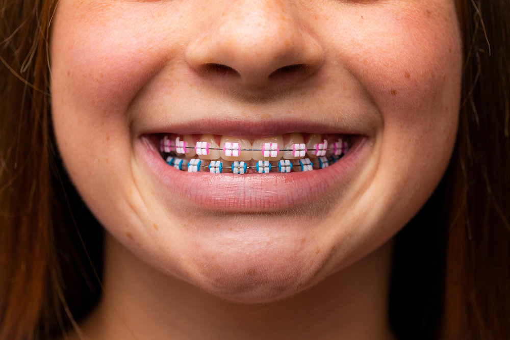 How Much Do Braces Cost in Charlottesville, VA? (Complete 2026 Guide) — orthodontic guidance from Dr. Suzanne Dennis