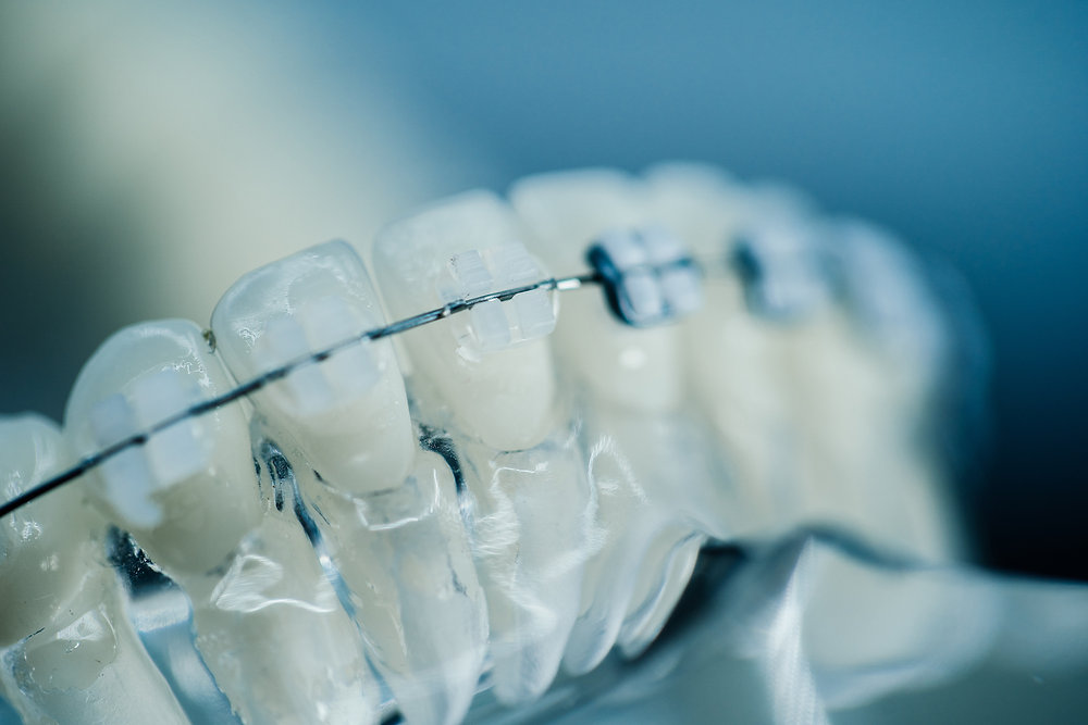 lightForce Braces VS Traditional Braces — orthodontic guidance from Dr. Suzanne Dennis