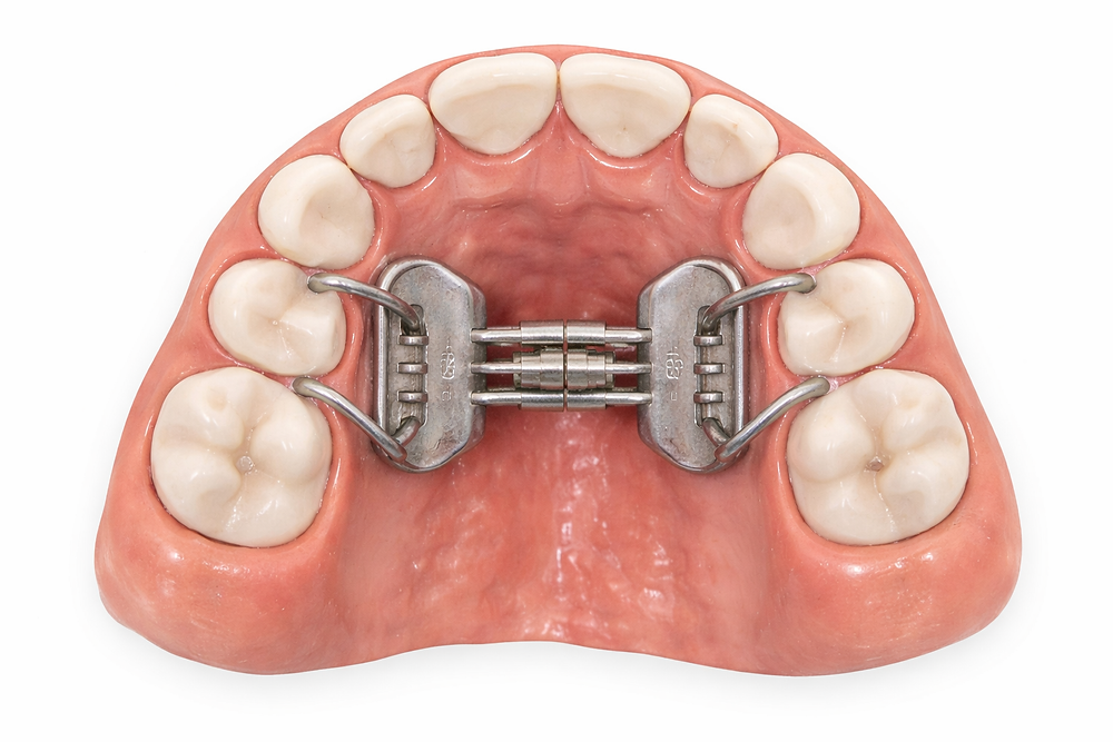 Understanding the Benefits of Palatal Expanders for Your Child's Dental Development — orthodontic guidance from Dr. Suzanne Dennis